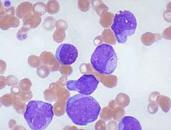 Picture 1 of Hope for leukemia patients