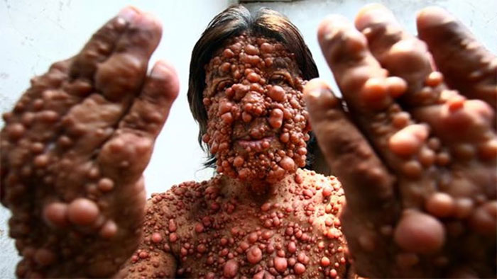 Picture 7 of Horror diseases are not for the weak