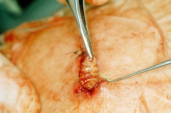 Picture 5 of Horrors of insects cause deformities of the human body