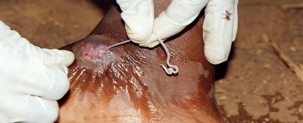 Picture 6 of Horrors of insects cause deformities of the human body