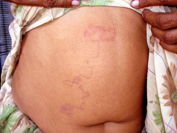 Picture 7 of Horrors of insects cause deformities of the human body