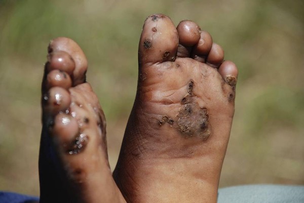 Picture 8 of Horrors of insects cause deformities of the human body