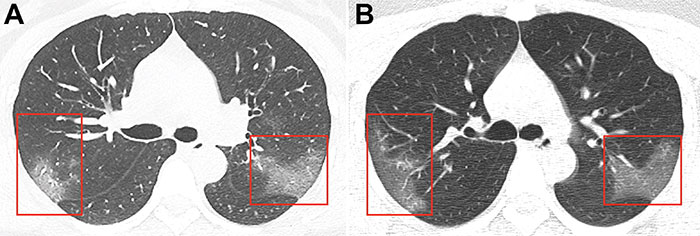 Picture 1 of Hot: Publish photos of lungs devoured by corona virus