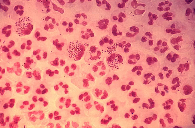 Picture 1 of How dangerous is gonorrhea?