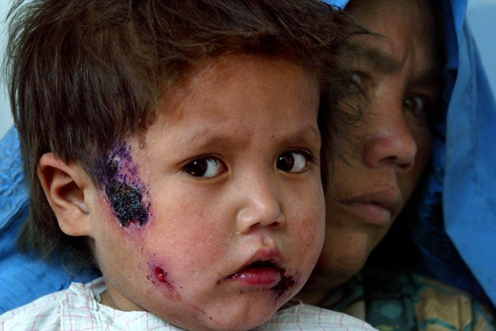 Picture 1 of How dangerous is the carnivorous parasite caused by IS