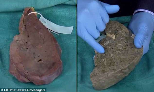 Picture 1 of How does beer devastate your liver?