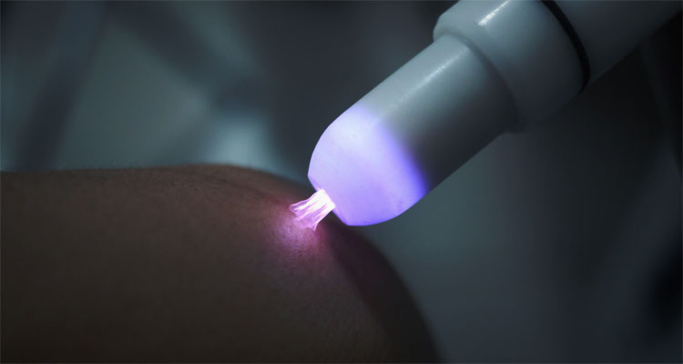 Picture 2 of How does cold plasma support healing open wounds?
