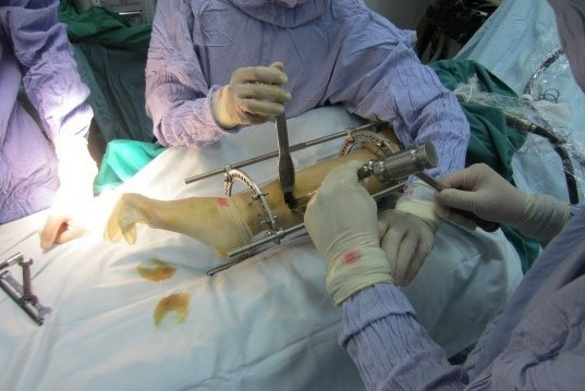 Picture 1 of How does leg lengthening surgery work?