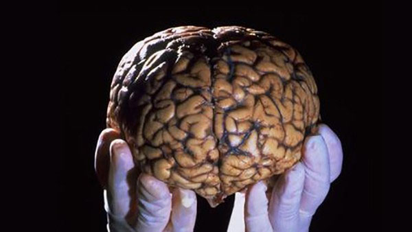 Picture 4 of How does man work if only half of his brain is left?