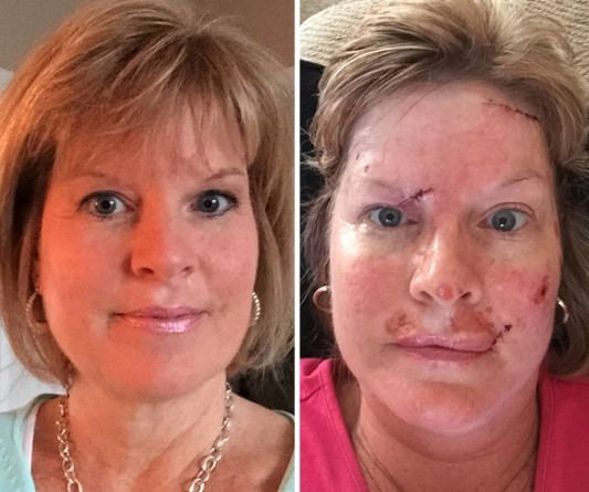 Picture 1 of How does skin cancer destroy people?