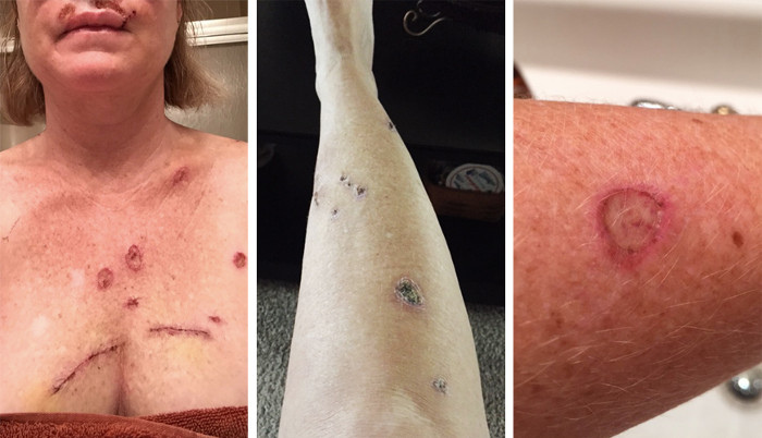Picture 2 of How does skin cancer destroy people?