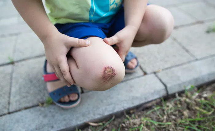 Picture 1 of How does the wound heal?