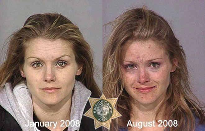 Picture 2 of How drugs destroy the human face
