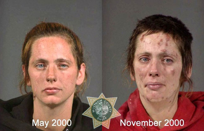Picture 5 of How drugs destroy the human face