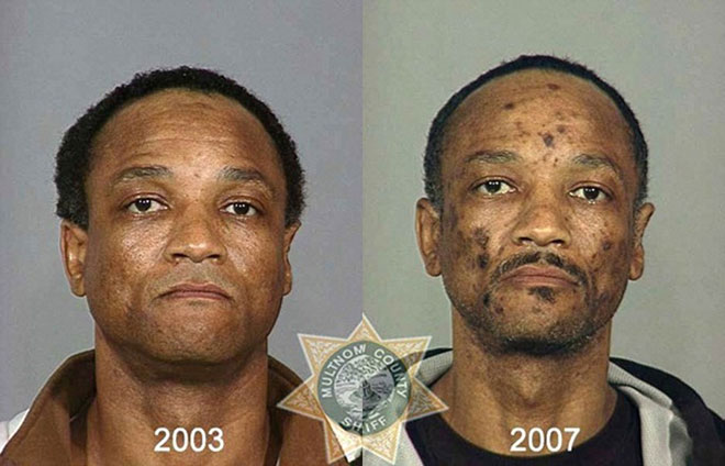 Picture 6 of How drugs destroy the human face