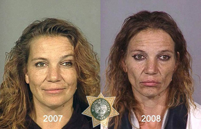 Picture 7 of How drugs destroy the human face