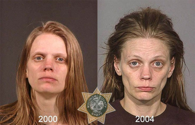 Picture 9 of How drugs destroy the human face