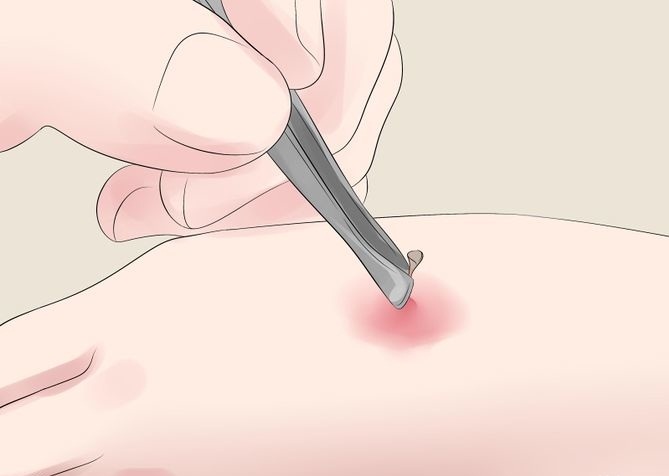 Picture 4 of How to deal with bee stings