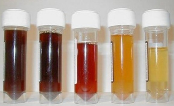 Picture 1 of How to guess disease from urine color