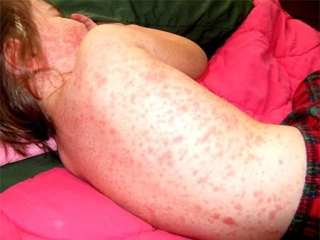 Picture 2 of How to identify children with dengue fever