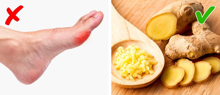 Picture 5 of How to limit the terrible pain caused by gout