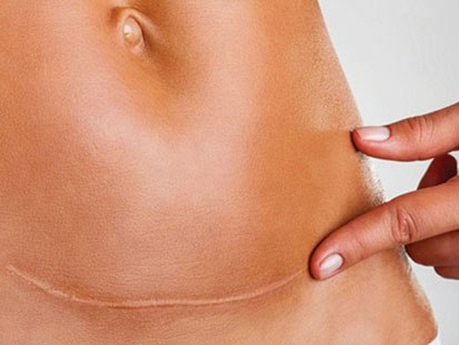 Picture 1 of How to make the incision heal?