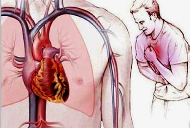 Picture 1 of How to manage when angina is present