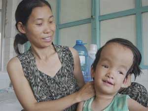 Picture 1 of Hydrocephalus in children: Treatable if taking advantage of