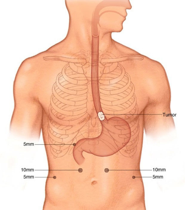 If you are lazy to do this routine every day, you may have esophageal cancer images 2