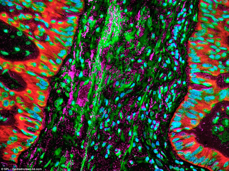 Picture 8 of Image of cancer cells under a microscope