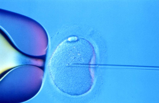 Picture 1 of In vitro fertilization causes complications of pregnancy