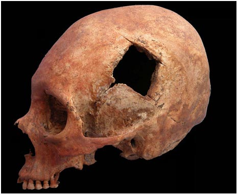 Picture 1 of Inca brain surgery of the form of
