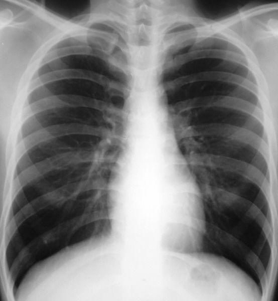 Picture 1 of Increasing popularity of new drug-resistant TB strains