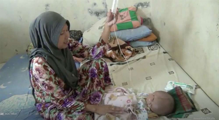 Picture 2 of Indonesian boys have the most rare malformations: born with 2 faces and 2 brains
