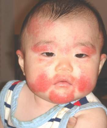 Picture 1 of Infant food allergy and how to manage