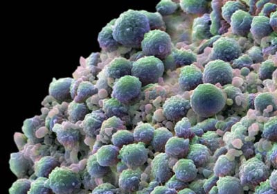 Picture 1 of Infertile men are more likely to develop adenocarcinoma