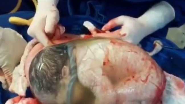 Picture 3 of Interesting truth about babies born in 'wrap things' 80,000 cases 1