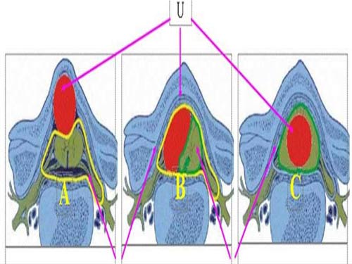 Internal myeloma: Early surgery helps to live long, less disabled! images 1