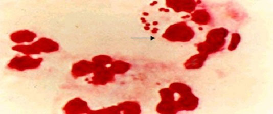 Picture 1 of Is it true that gonorrhea spreads through ... washing machine?