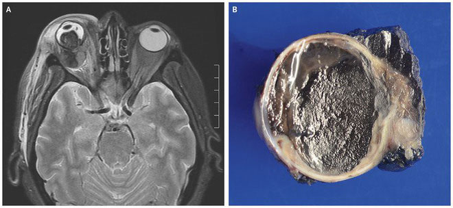 Picture 2 of It turns out that the iris may also have cancer, and what happens afterwards will startle you
