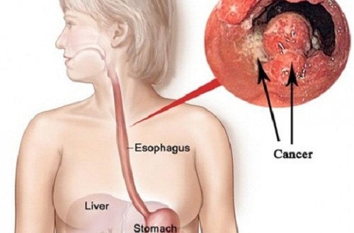 Picture 1 of Japan announced a new method of treating esophageal cancer