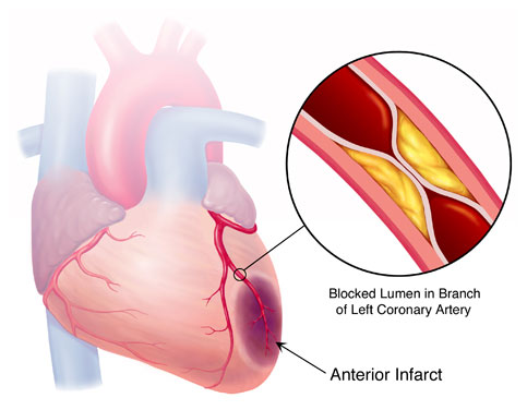 Picture 1 of Kardiosens device warns early myocardial infarction