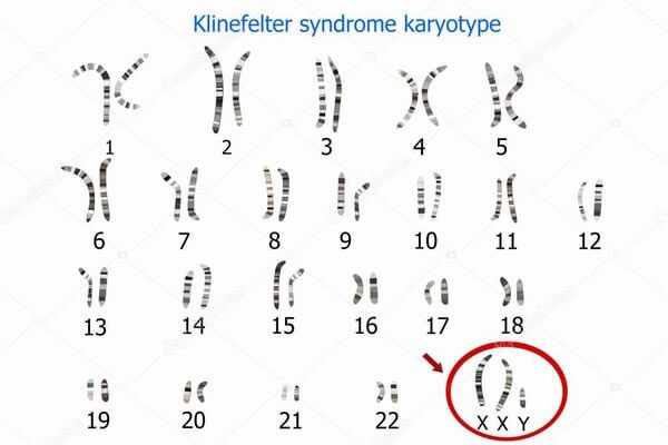 Picture 1 of Klinefelter Syndrome - Men carry the female gene