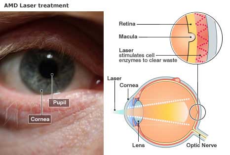 Picture 1 of Laser light prevents disease due to retinal degeneration