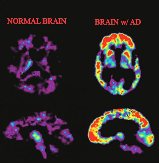 Picture 2 of Latest model of Alzheimer's causes