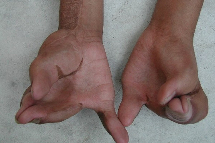 Picture 2 of Learn about the rare disease called: Apert Syndrome