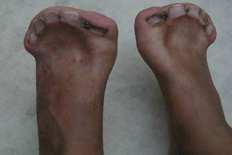 Picture 3 of Learn about the rare disease called: Apert Syndrome
