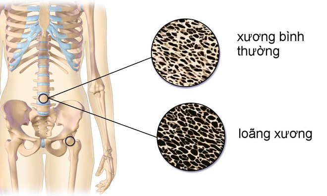 Picture 1 of Learn about the role of vitamin K in the body