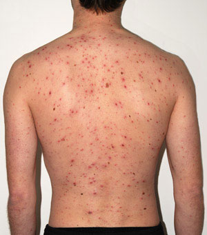 Picture 5 of Learn and prevent common diseases in the spring