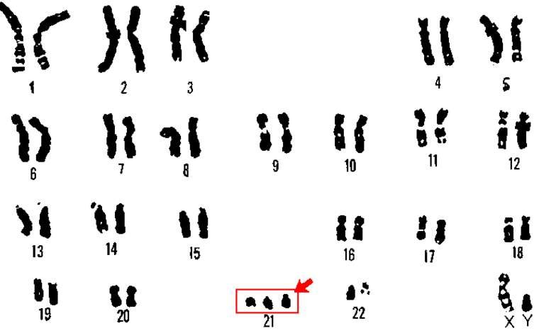 Picture 2 of Learn Down syndrome and the truth you should know